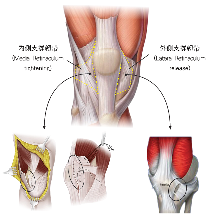 肌腱炎